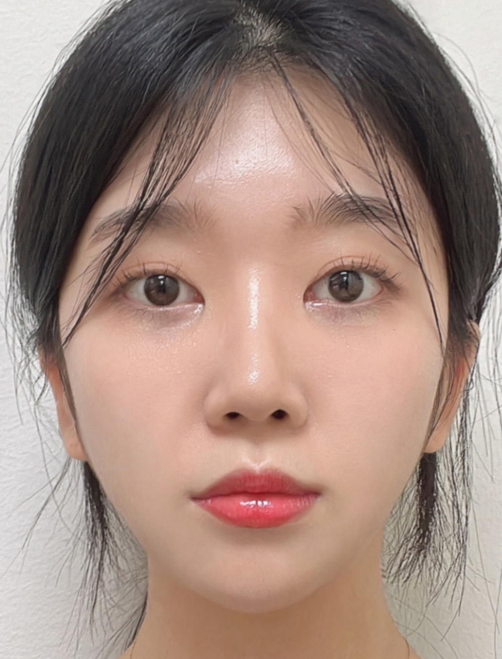 pangpang clinic korea - Before And After