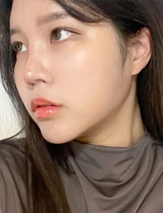 pangpang clinic korea - Before And After