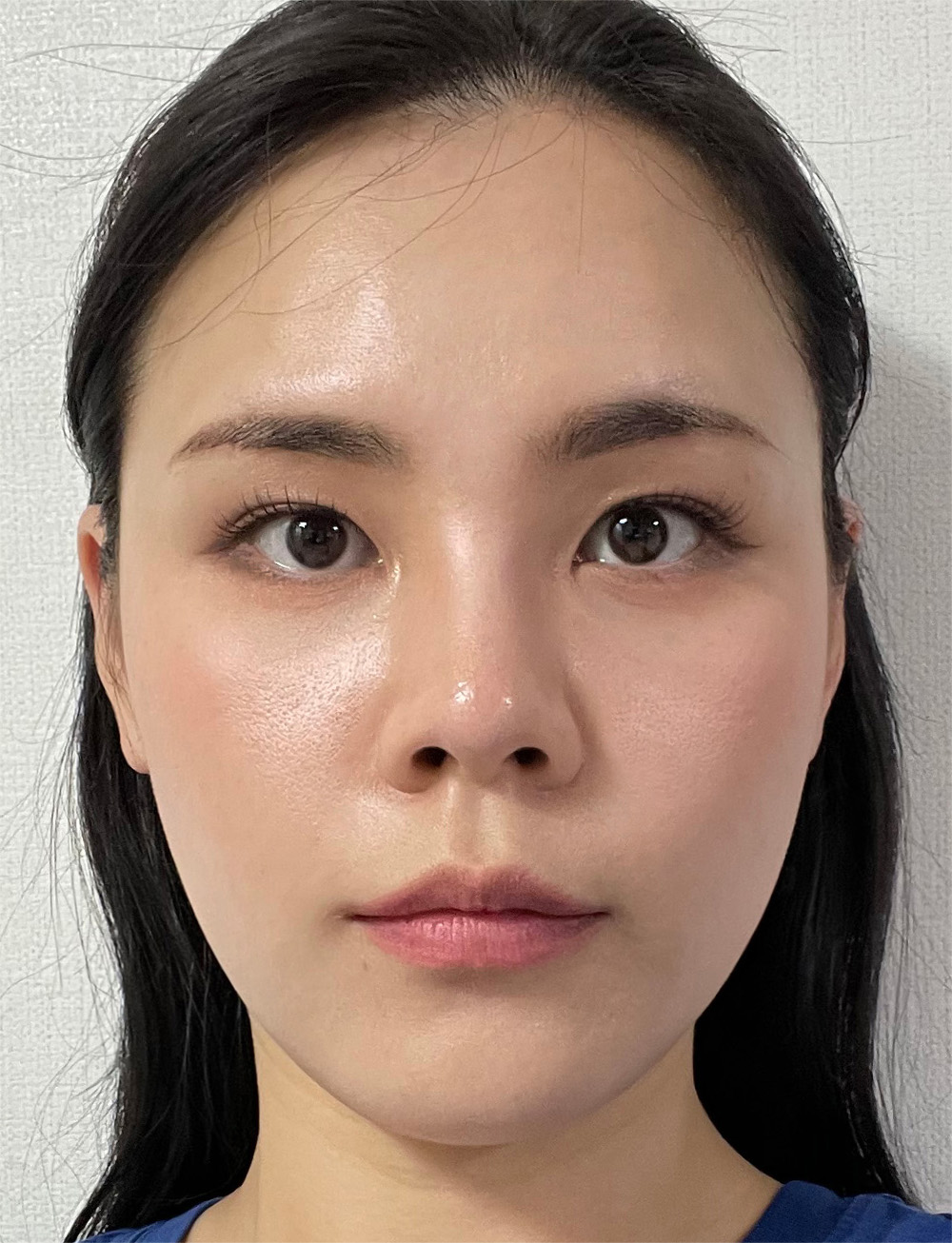 pangpang clinic korea - Before And After
