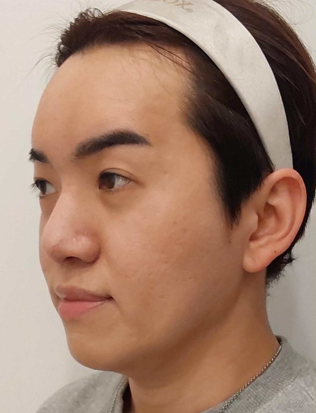 pangpang clinic korea - Before And After