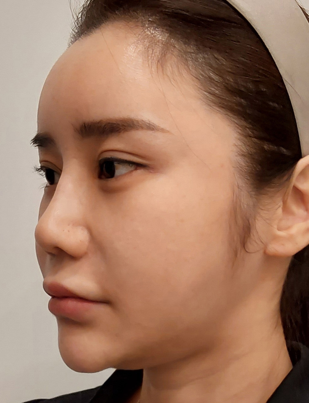 pangpang clinic korea - Before And After