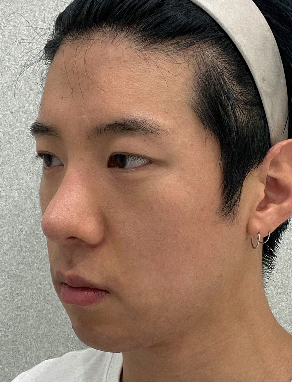 pangpang clinic korea - Before And After