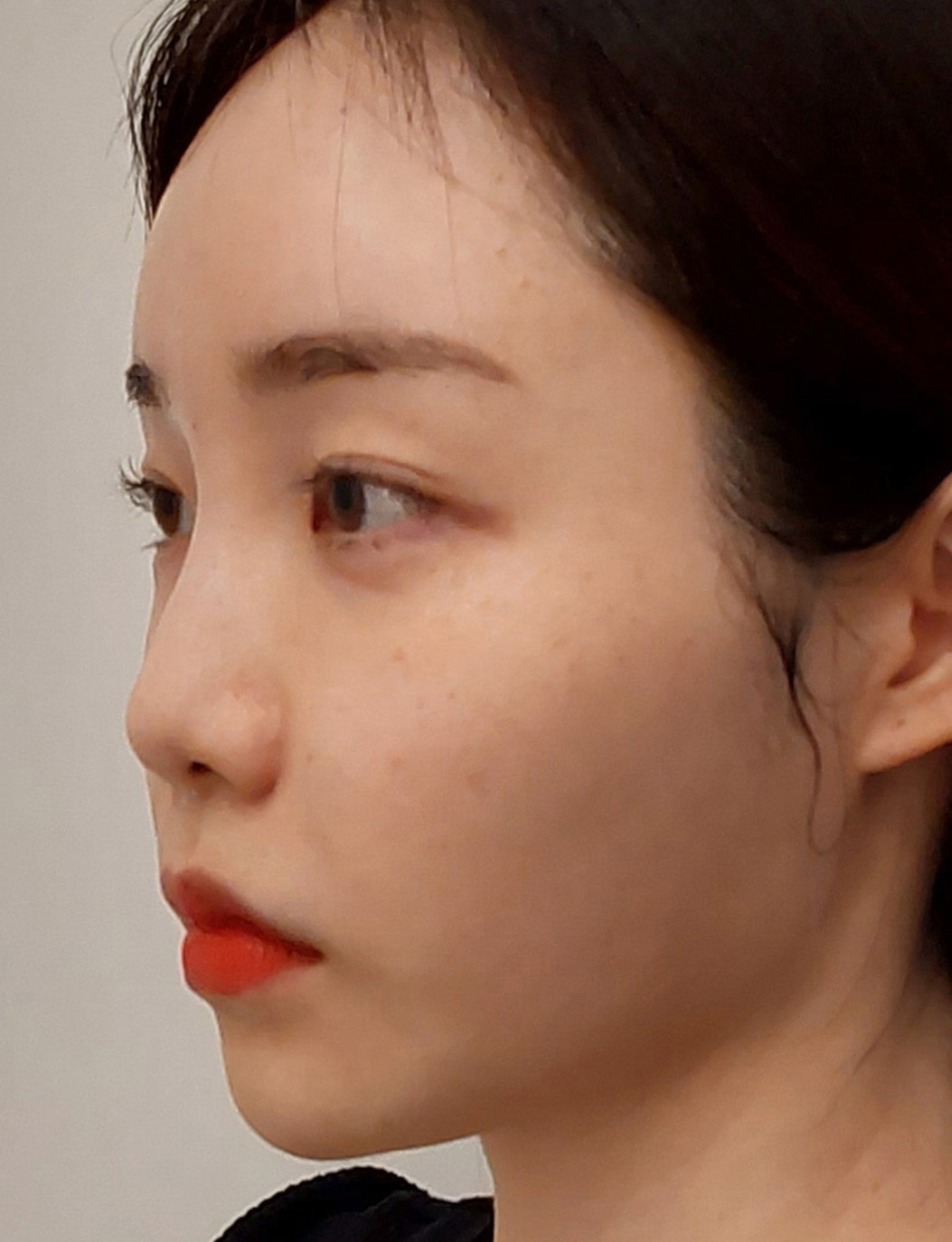 pangpang clinic korea - Before And After