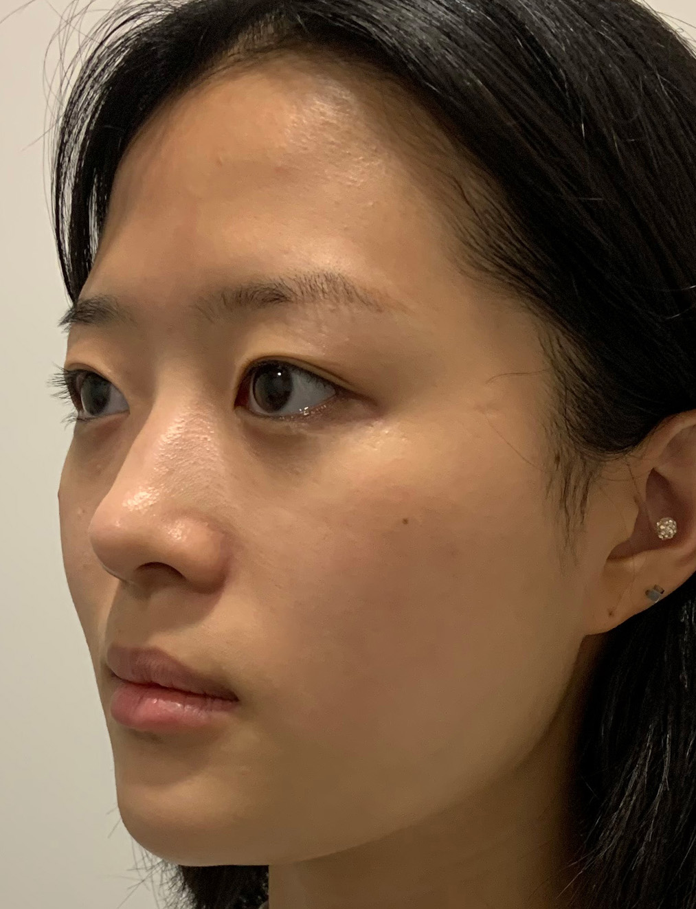 pangpang clinic korea - Before And After