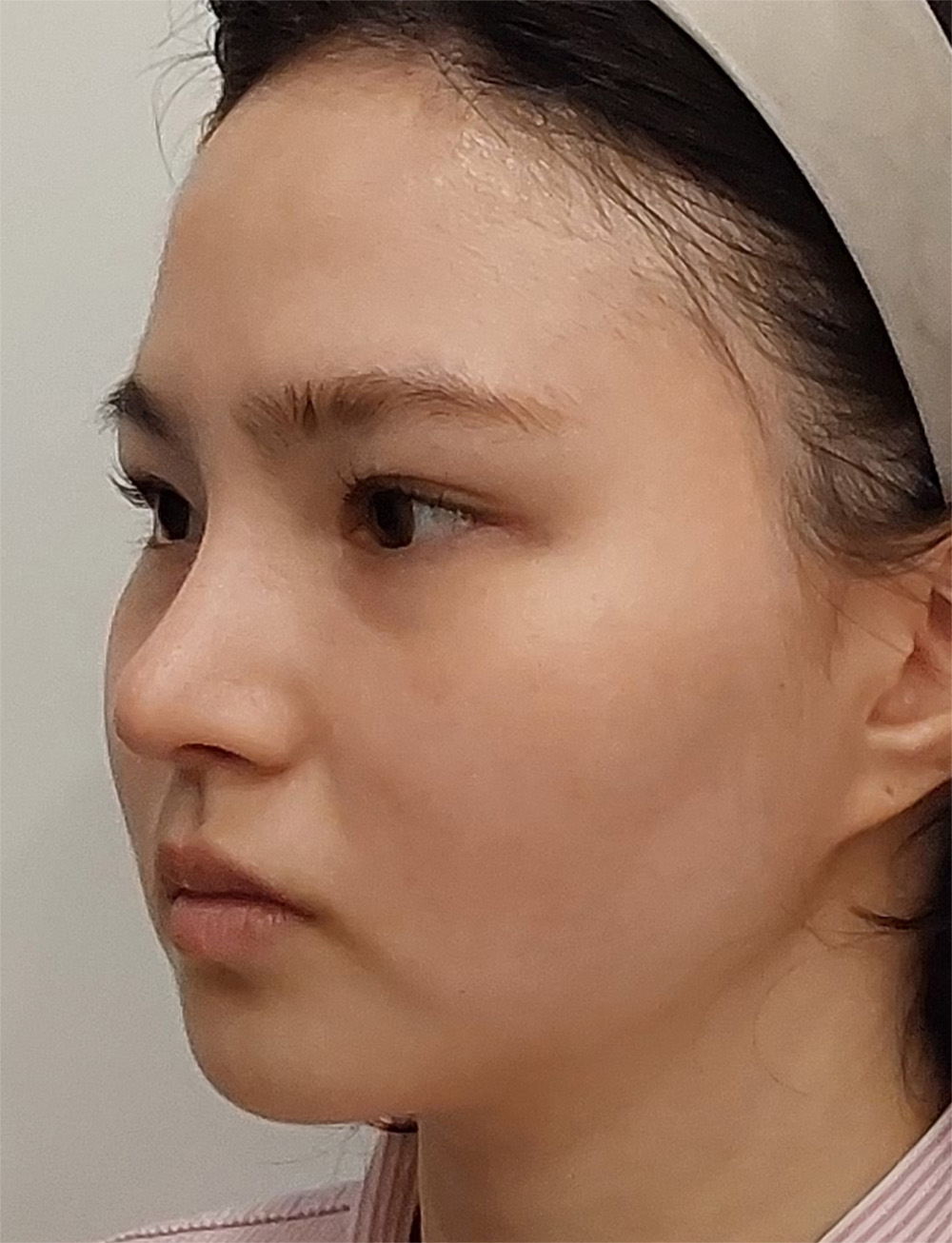pangpang clinic korea - Before And After