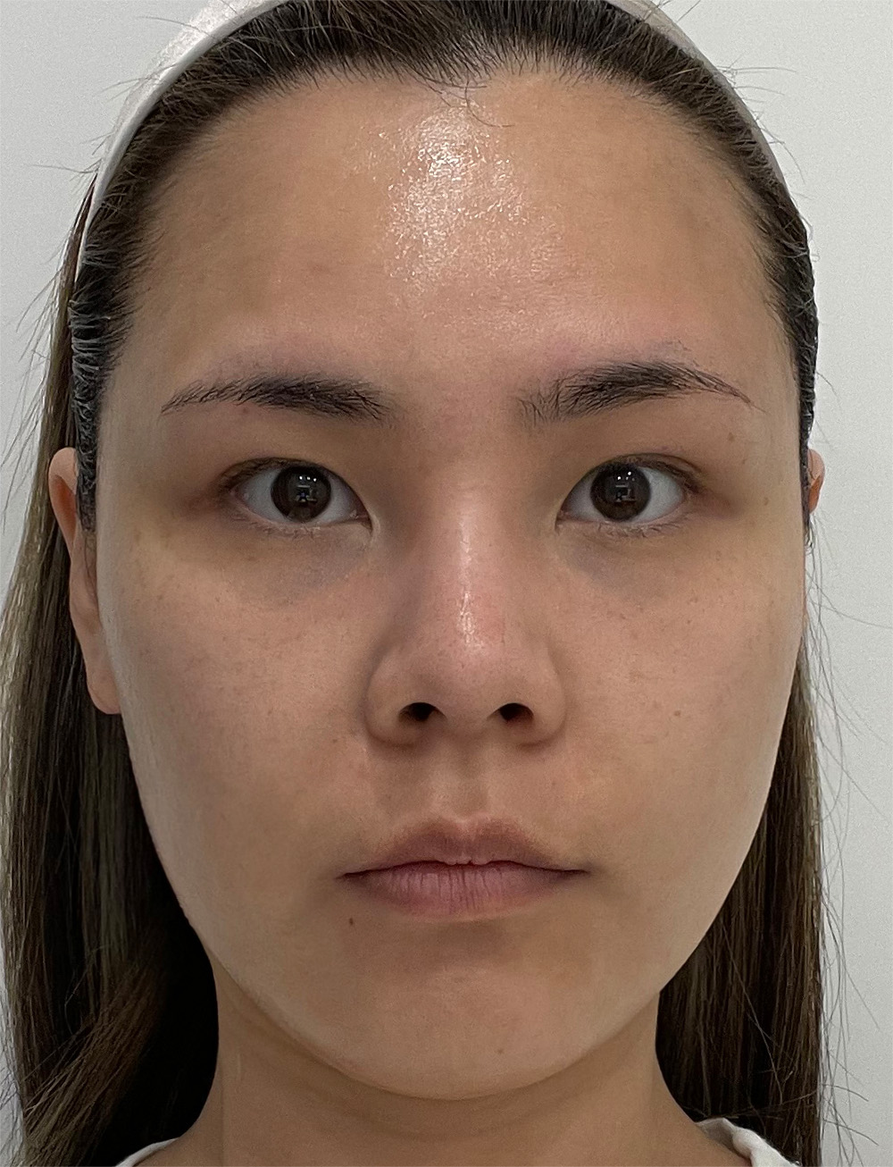 pangpang clinic korea - Before And After