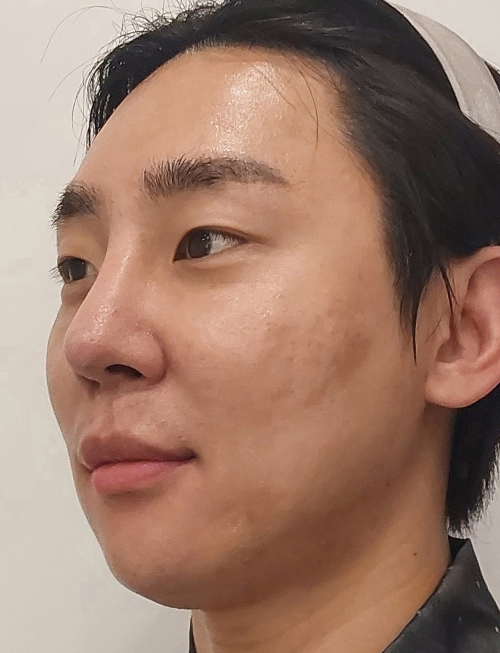 pangpang clinic korea - Before And After