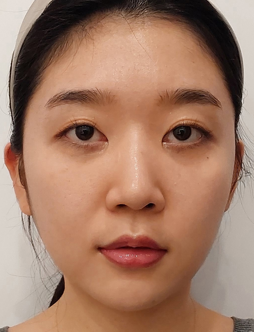 pangpang clinic korea - Before And After