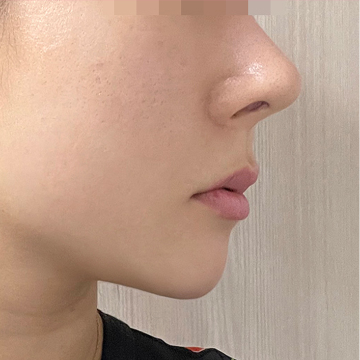 double chin thread lifting in korea pang pang clinic