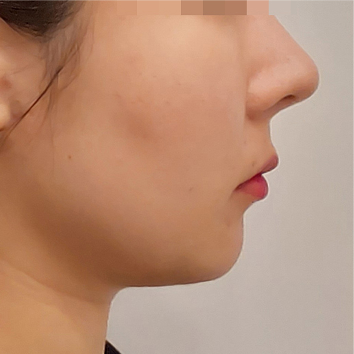 double chin thread lifting in korea pang pang clinic