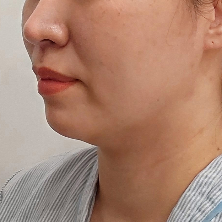 double chin thread lifting in korea pang pang clinic